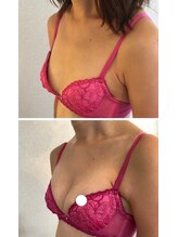 美人バスト 豊橋店/バストアップ症例【バストケア】