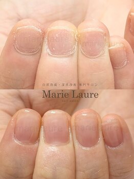 マリーロール 梅田店(Marie Laure)/深爪矯正/自爪育成/自爪風