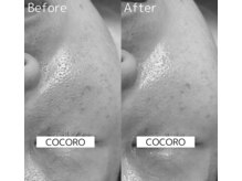 ココロ(COCORO)/プラピール1回施術