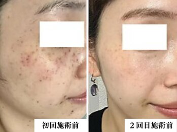 リコス(LICCO’S)/光フォト シミケア1回