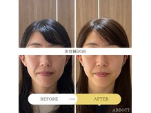 アボット(ABBOTT)の雰囲気（美容鍼1回目と10回目との比較。ほうれい線が薄くなりました！）