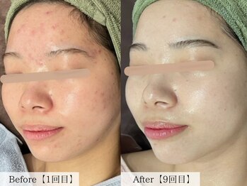 オーキッド(ORCHID)/ニキビケア♪