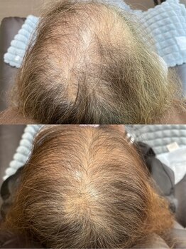 ユウユウ(YUYU)/頭皮改善☆プロセルセラピーズ