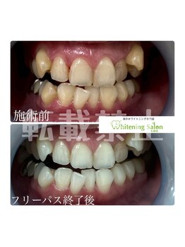ホワイトニングサロン 札幌店/【ホワイトニング】#札幌#大通り