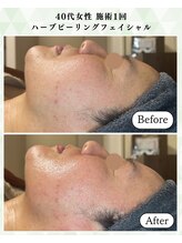 シーフェイス 横浜店(SEE FACE)/40代ハーブピーリングモニター