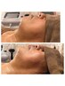 【男性専用クーポン】気になる顔のたるみに!35歳以上のお悩みにおすすめ♪