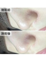 美鼻ラボ 押上 曳舟/少しの詰まりもこんなに！