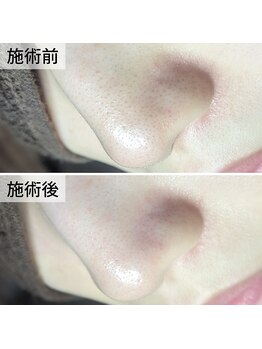 美鼻ラボ 押上 曳舟/少しの詰まりもこんなに!