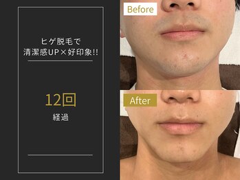 ステイゴールド 新百合ヶ丘(STAY GOLD)/おヒゲ脱毛の経過☆