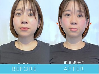 ビューティーマジック 恵比寿 広尾(beauty magic)/小顔矯正術 頭顔骨コース1回