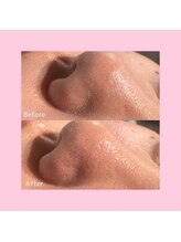 ホワイトラボ 新潟万代(White labo)/【施術例】ハイドロフェイシャル