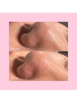 ホワイトラボ 新潟万代(White labo)/【施術例】ハイドロフェイシャル