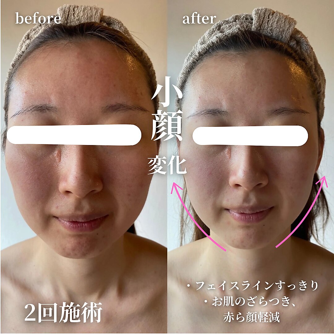 アルファライン.痩身.小顔.リフトアップ.業務用 (メンズ向け アルファライン.痩身.小顔.リフトアップ.業務用 (メンズ向け