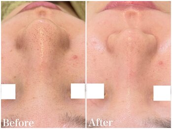 サロンドフェイス(Salon de Faith)/【フォト+ハーブ】1回施術♪