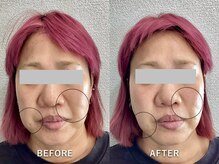 ワイ(Y)/たる改善でほうれい線が薄く！！