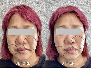 ワイ(Y)/たる改善でほうれい線が薄く!!