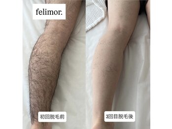 フェリモール(Felimor.)/メンズ光脱毛