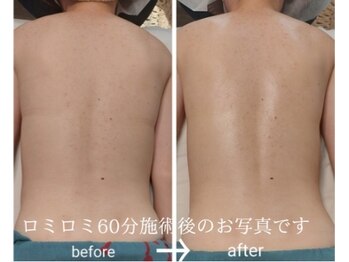 ラグーン(LAGOON)/ロミロミ60分施術前後のお写真