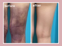 コネクト/術後ケアインディバ