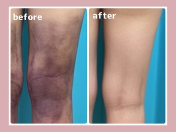 コネクト/術後ケアインディバ