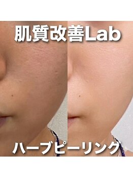 肌質改善Lab｜韓国美容/毛穴/ハーブピーリング/ニキビケア｜/ハーブピーリング｜ニキビケア