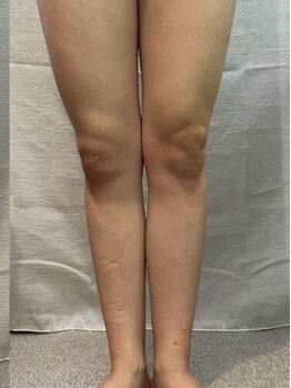 レディア(Re:Dear)の写真/【スラリと綺麗な脚のシルエットへ】内側と外側の両面からアプローチする骨格矯正で歪みを改善◇