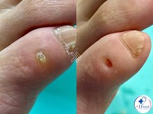 プラスワンフット 本厚木(+1 Foot)/タコ・魚の目ケア！痛みから解放