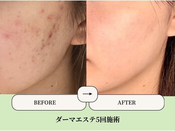 ベネミー 恵比寿(Benemi)の写真/【おすすめ】 エステ版ダーマエステ★しぶといニキビケア・頑固な毛穴ケア