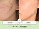 ベネミー 恵比寿(Benemi)の写真/【おすすめ】 エステ版ダーマエステ★しぶといニキビケア・頑固な毛穴ケア