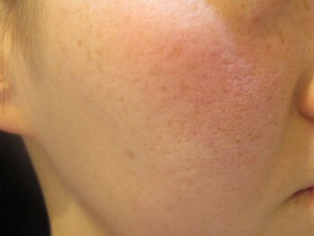 エステティックガーデン小町ストーリー/シミ改善【アフター】