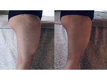 ティアラ(tiara)/太もも集中！1回before→after