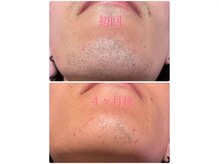 プラス ファースト(Plus 1st)/ヒゲ脱毛♪