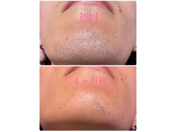 プラス ファースト(Plus 1st)/ヒゲ脱毛♪