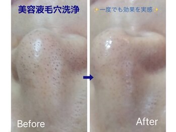 ルアナ(Luana)/美容液毛穴洗浄+美容液導入