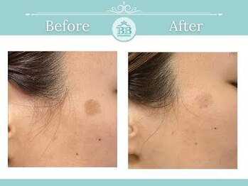 シミケアゼロ美人 表参道店(シミケアZERO美人)/【シミケア★シミゼロ症例】