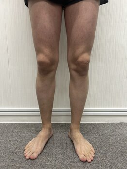 ブリッジ(BRIDGE)/メンズ全身脱毛12回目