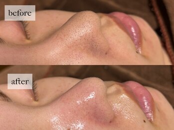 ヒナノ 矢場町店(HINANO)/ハイドラ毛穴洗浄