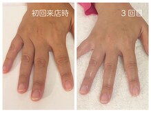 キレイテ 福岡天神店/ゴワつきと黄ぐすみ