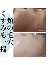 癒える(ielu)/剥けないハーブピーリング