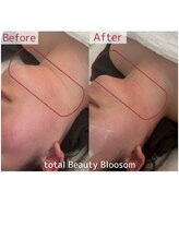 Blossom 【ホワイトニング/脱毛/韓国肌管理/毛穴洗浄】【3/23 NEW OPEN(予定)】/REDSHOT　顎下