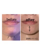 ディアユー(Dearyou)/顎のたるみ改善