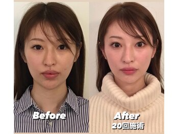 コルミチョン サロン(骨美整 salon)/Before・After 20回施術
