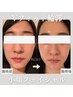 瞬間小顔【燃焼手技付き60分】針を使わない脂肪分解10mL導入¥30,000→¥18,000