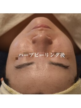 ココルーネ(COCORUNE)/シルク肌ハーブピーリング