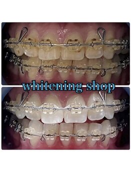 ホワイトニングショップ 池田店/【BEFORE/AFTER】