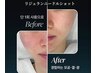 韓国美容皮膚科発】NAD&リジュランニードルショット★遺伝子再生/水光透明肌