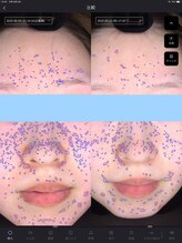 ウニ(uni)/オーダーメイド肌管理の症例です