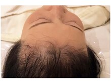 イーズ/リバイタ グランツリー武蔵小杉店/【ケース3】60代女性　before