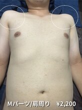 カナウ(KANAU)/【Mパーツ/脱毛】肩周り