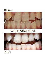 ホワイトニングショップ 徳島藍住店/Before After美白ホワイトニング
